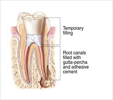 root canal 4